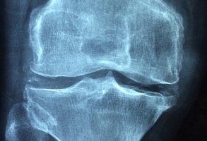 Bezpłatne badania w kierunku rozpoznania osteoporozy
